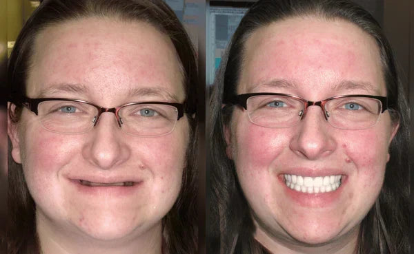 Prothèse dentaire esthétique amovible supérieure et inférieure, couleur ivoire, pour un sourire éclatant, confortable et naturel | Sulvida