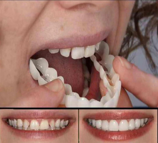 Cosmetisch Opzetgebit Tijdelijke Tanden Siliconen Flexibel Natuurlijk Wit Smile Protese Veneer Kunstgebit | Sulvida