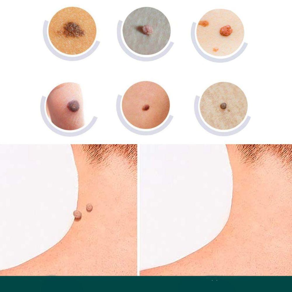 Huidvlekken- en wratten-verwijderpleisters met Hydrocolloïd – Pijnloos & Discreet – 120 Stuks | Sulvida