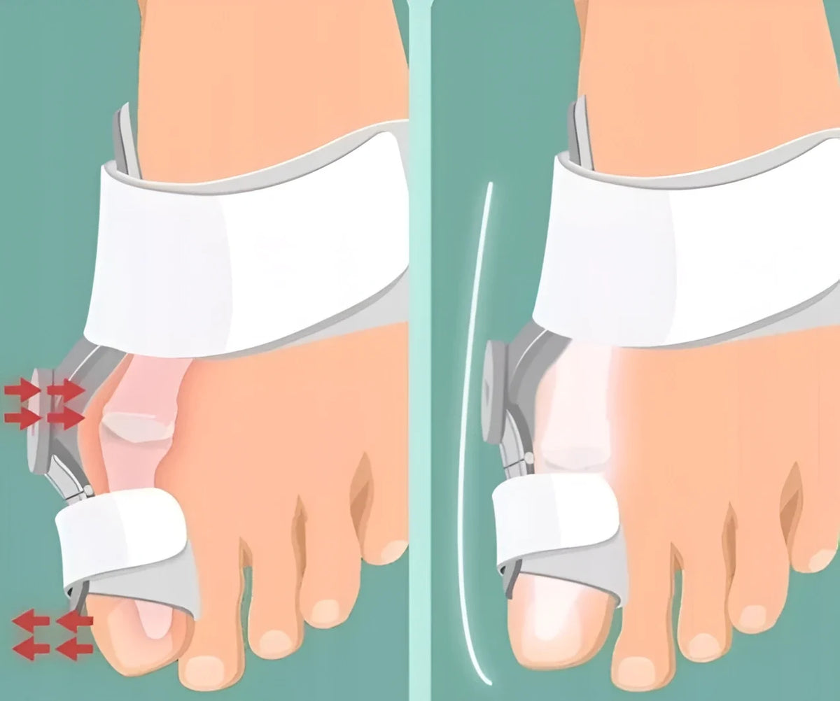 Orthopedische Teenbeugel Verstelbaar Hallux Valgus Correctie Nacht & Dag Draagbaar Pijnverlichting Comfortabel | Sulvida