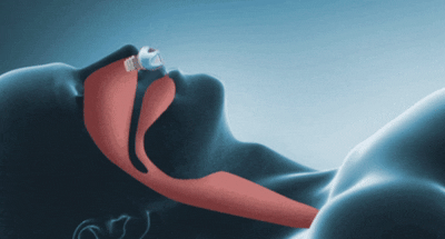 Mini CPAP-Masker voor Apneu – Draadloos Slaaphulpmiddel Anti-Snurk voor Rustgevende Nachten en Comfort | Sulvida