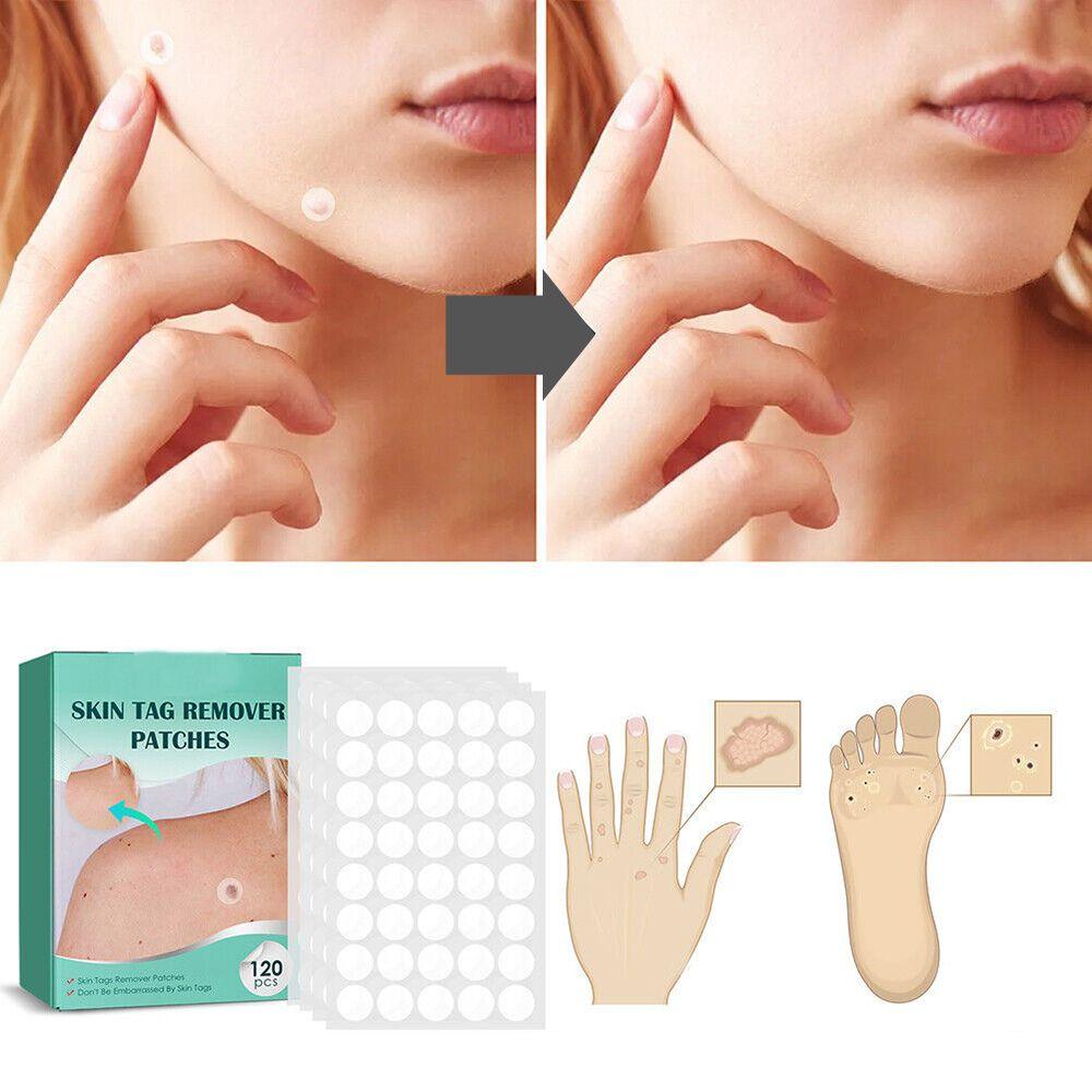 Huidvlekken- en wratten-verwijderpleisters met Hydrocolloïd – Pijnloos & Discreet – 120 Stuks | Sulvida