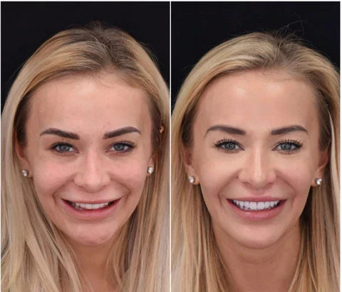 Snap-On Veneers Boventanden Ondertanden Natuurlijke Glimlach Verwijderbaar Pasvorm Kunstgebit Cosmetisch | Sulvida