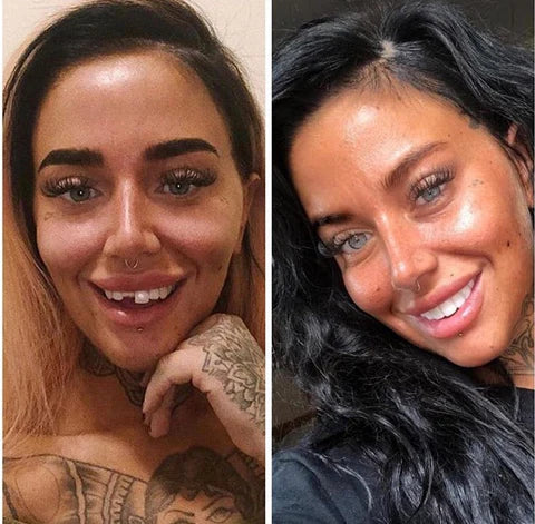 Snap-On Veneers Boventanden Ondertanden Natuurlijke Glimlach Verwijderbaar Pasvorm Kunstgebit Cosmetisch | Sulvida