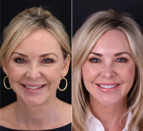 Snap-On Veneers Boventanden Ondertanden Natuurlijke Glimlach Verwijderbaar Pasvorm Kunstgebit Cosmetisch | Sulvida