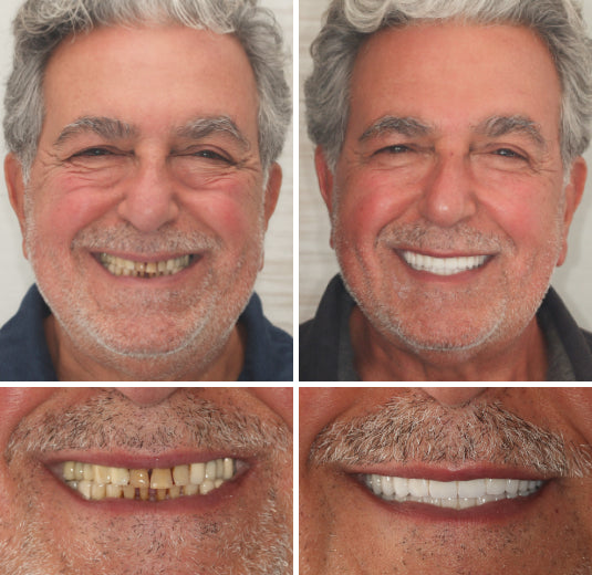 Prothèse dentaire esthétique amovible supérieure et inférieure, couleur ivoire, pour un sourire éclatant, confortable et naturel | Sulvida