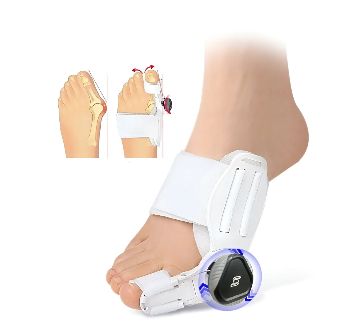 Orthopedische Teenbeugel Verstelbaar Hallux Valgus Correctie Nacht & Dag Draagbaar Pijnverlichting Comfortabel | Sulvida